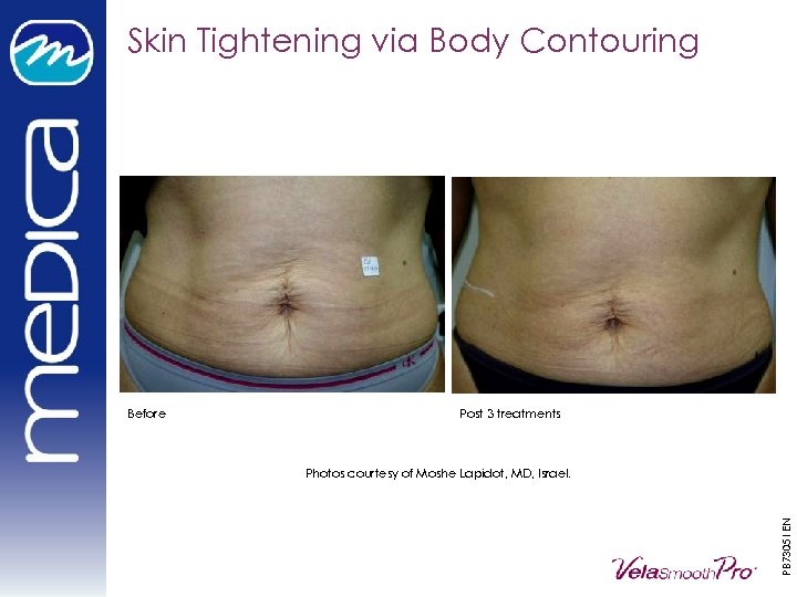 Skin Tightening via Body Contouring Post 3 treatments Photos courtesy of Moshe Lapidot, MD,