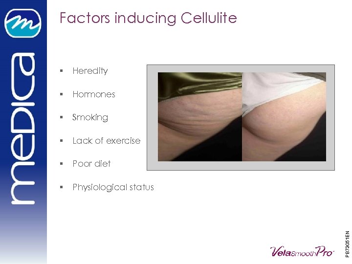 Factors inducing Cellulite Heredity § Hormones § Smoking § Lack of exercise § Poor