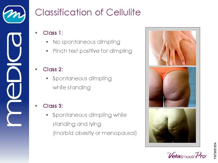 Classification of Cellulite § Class 1: § No spontaneous dimpling § Pinch test positive