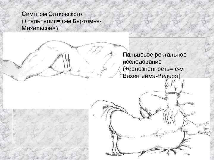 Симптом Ситковского (+пальпация= с-м Бартомье. Михельсона) Пальцевое ректальное исследование (+болезненность= с-м Вахенгейма-Редера) 