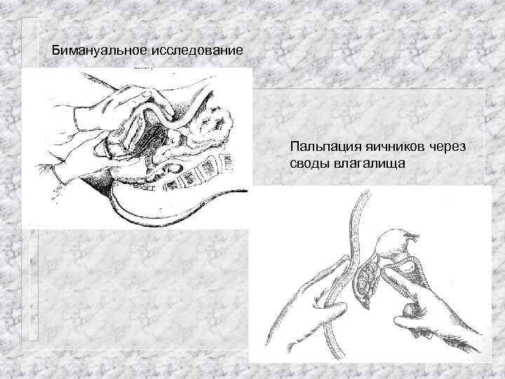 Бимануальное исследование Пальпация яичников через своды влагалища 