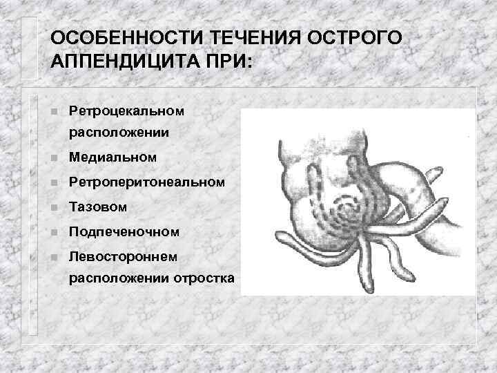 ОСОБЕННОСТИ ТЕЧЕНИЯ ОСТРОГО АППЕНДИЦИТА ПРИ: n Ретроцекальном расположении n Медиальном n Ретроперитонеальном n Тазовом