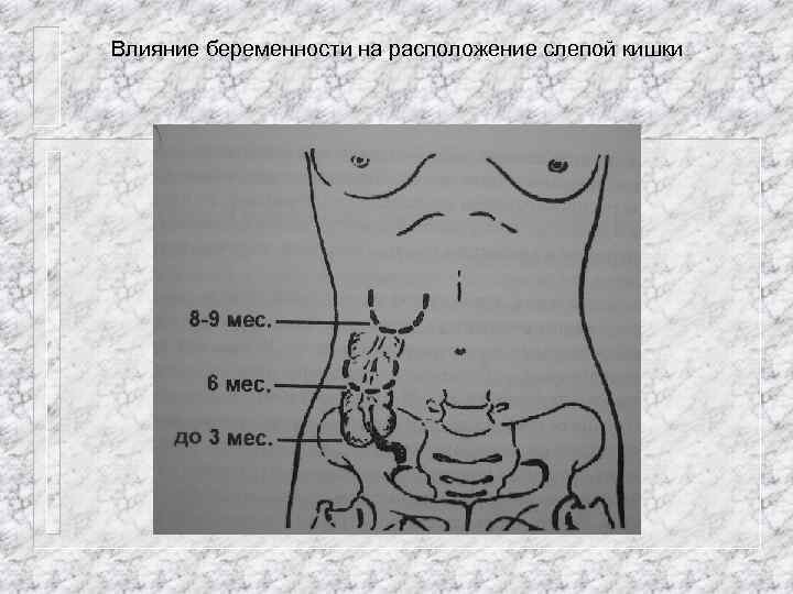 Влияние беременности на расположение слепой кишки 