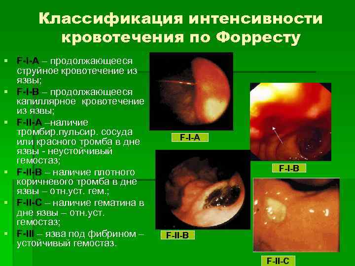 Желудочное кровотечение карта вызова скорой