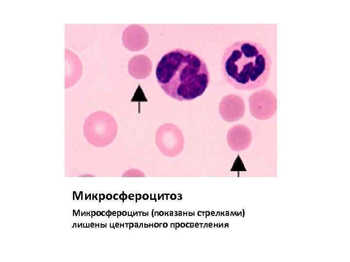 Микросфероцитоз Микросфероциты (показаны стрелками) лишены центрального просветления 