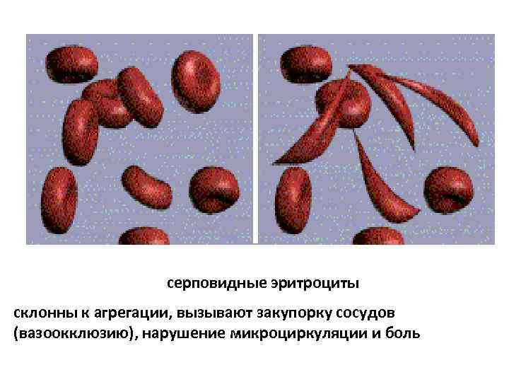 серповидные эритроциты склонны к агрегации, вызывают закупорку сосудов (вазоокклюзию), нарушение микроциркуляции и боль 