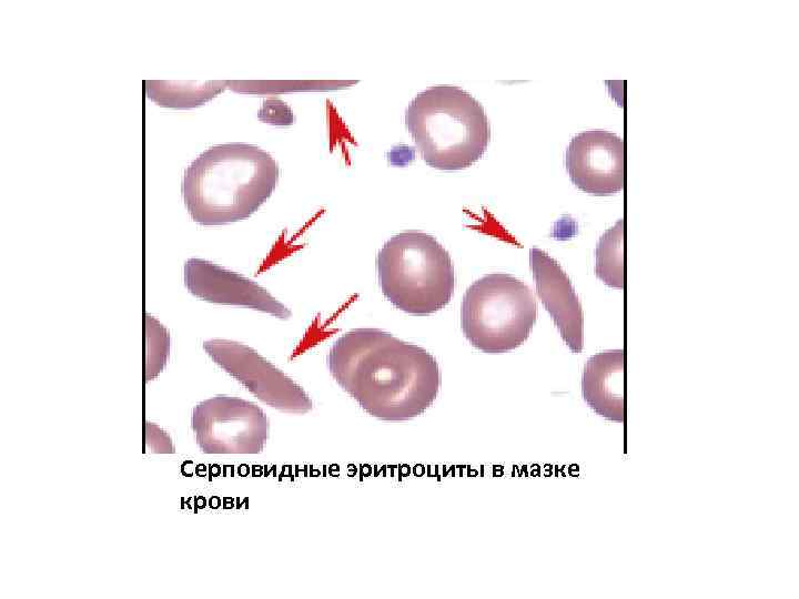 Серповидные эритроциты в мазке крови 