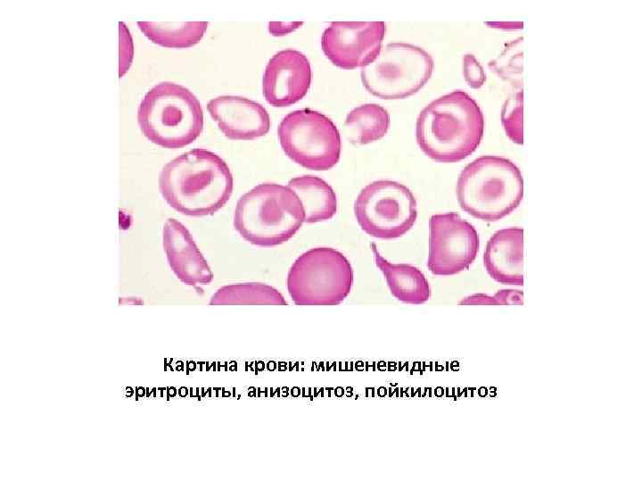 Картина крови: мишеневидные эритроциты, анизоцитоз, пойкилоцитоз 