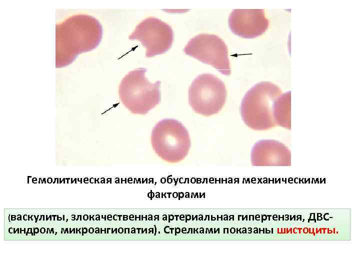 Гемолитическая анемия, обусловленная механическими факторами (васкулиты, злокачественная артериальная гипертензия, ДВС- синдром, микроангиопатия). Стрелками показаны