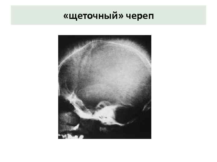  «щеточный» череп 