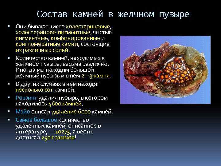 Состав камней в желчном пузыре Они бывают чисто холестериновые, холестериново-пигментные, чистые пигментные, комбинированные и