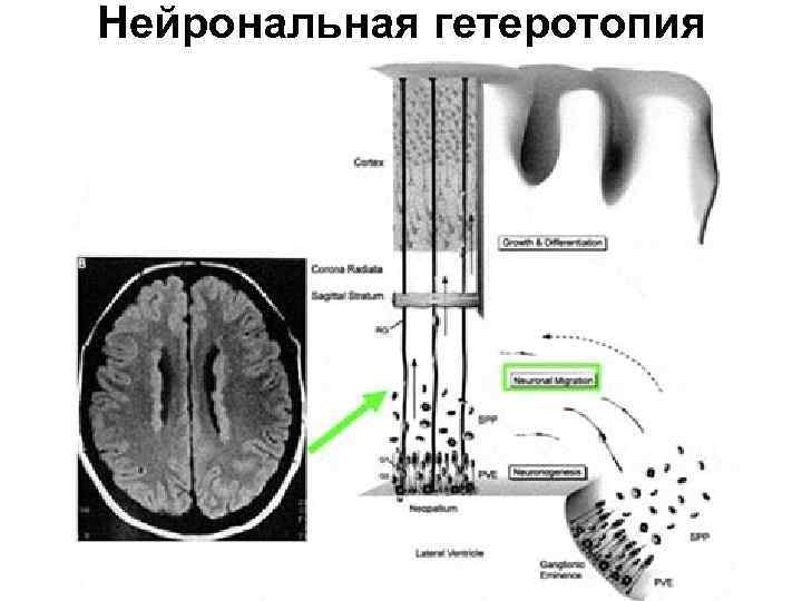 Гетеротопия