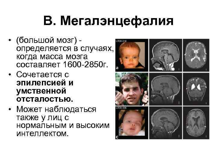 B. Мегалэнцефалия • (большой мозг) определяется в случаях, когда масса мозга составляет 1600 -2850