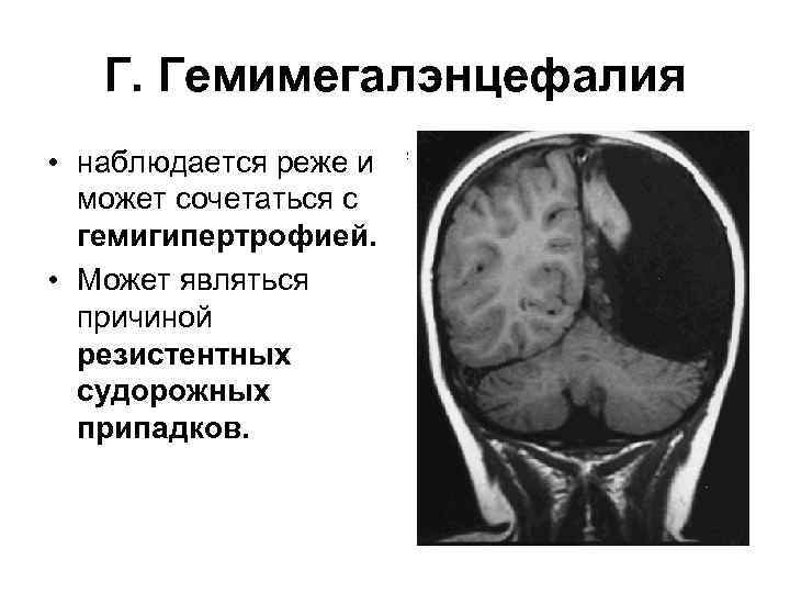 Г. Гемимегалэнцефалия • наблюдается реже и может сочетаться с гемигипертрофией. • Может являться причиной