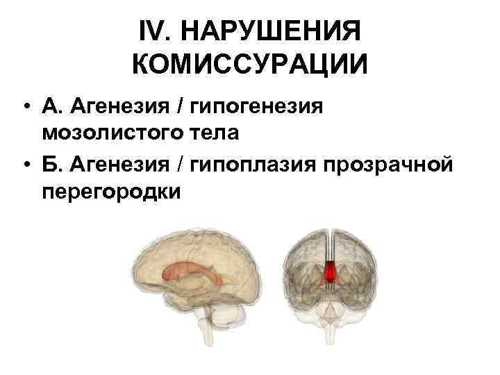 IV. НАРУШЕНИЯ КОМИССУРАЦИИ • А. Агенезия / гипогенезия мозолистого тела • Б. Агенезия /