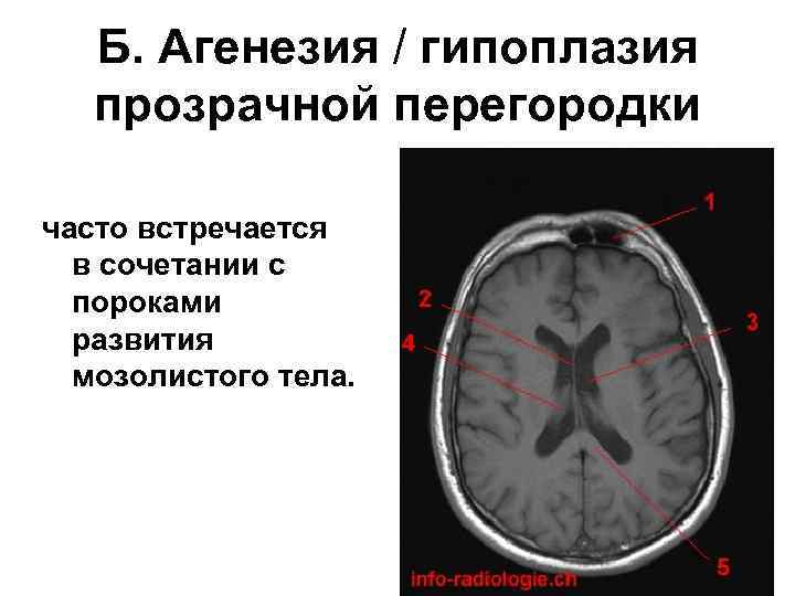 Гипоплазия правой головного мозга. Аплазия прозрачной перегородки головного мозга. Агенезия мозолистого тела головного мозга. Аномалия агенезия мозолистого тела. Агенезия прозрачной перегородки головного мозга.