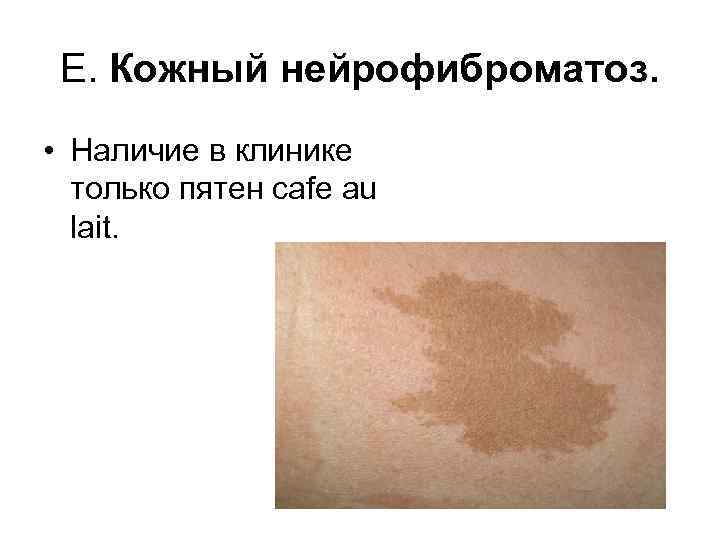 Е. Кожный нейрофиброматоз. • Наличие в клинике только пятен cafe au lait. 