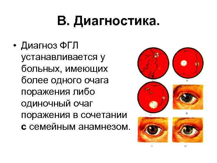 В. Диагностика. • Диагноз ФГЛ устанавливается у больных, имеющих более одного очага поражения либо