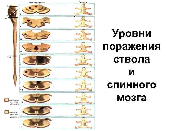Уровни поражения ствола и спинного мозга 