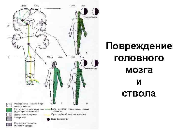 Повреждение головного мозга и ствола 