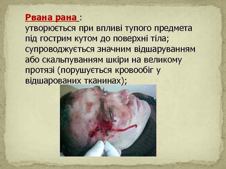 Рвана рана : утворюється при впливі тупого предмета під гострим кутом до поверхні тіла;