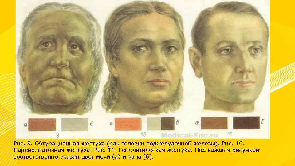 Рис. 9. Обтурационная желтуха (рак головки поджелудочной железы). Рис. 10. Паренхиматозная желтуха. Рис. 11.