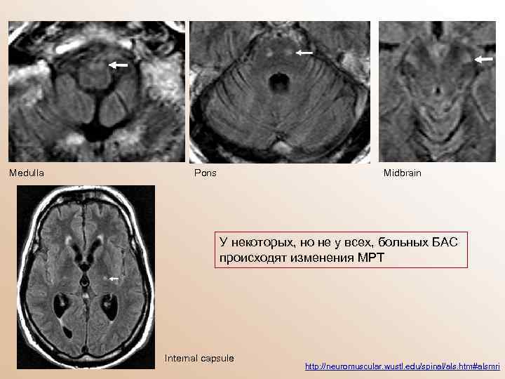 Medulla Pons Midbrain У некоторых, но не у всех, больных БАС происходят изменения МРТ