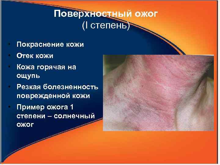 Поверхностный ожог (I степень) • Покраснение кожи • Отек кожи • Кожа горячая на