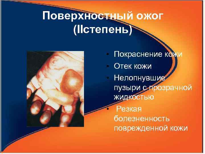 Поверхностный ожог (IIстепень) • Покраснение кожи • Отек кожи • Нелопнувшие пузыри с прозрачной