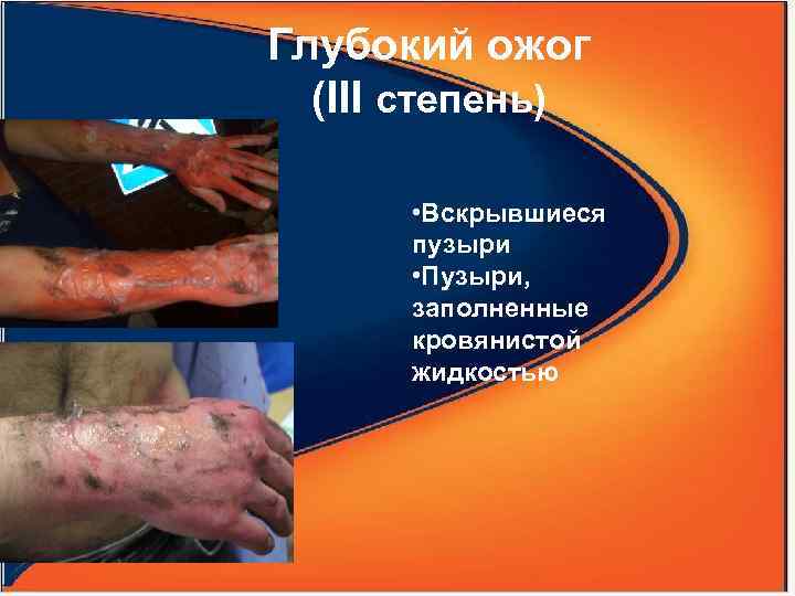 Глубокий ожог (III степень) • Вскрывшиеся пузыри • Пузыри, заполненные кровянистой жидкостью 