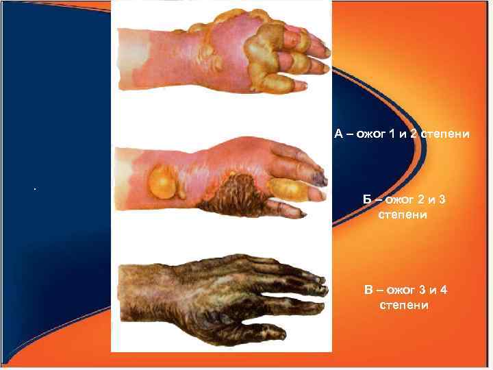 А – ожог 1 и 2 степени . Б – ожог 2 и 3