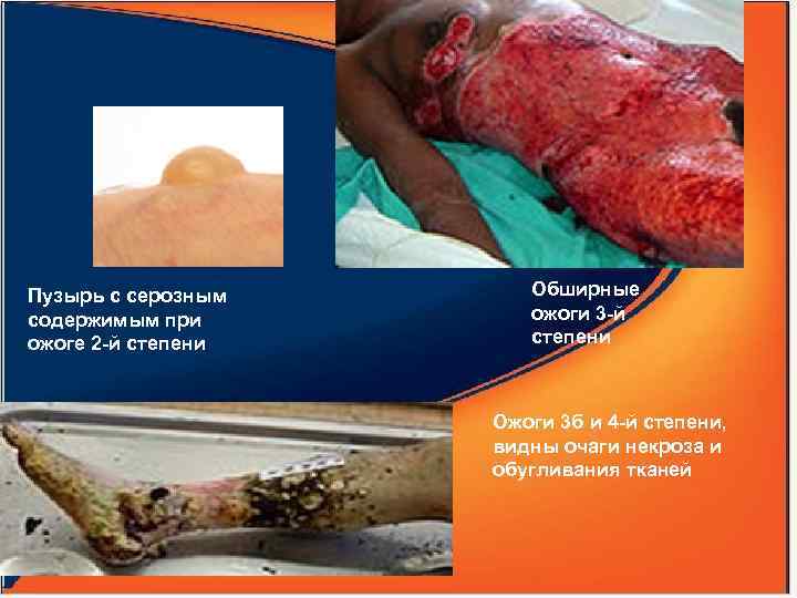 Пузырь с серозным содержимым при ожоге 2 -й степени Обширные ожоги 3 -й степени