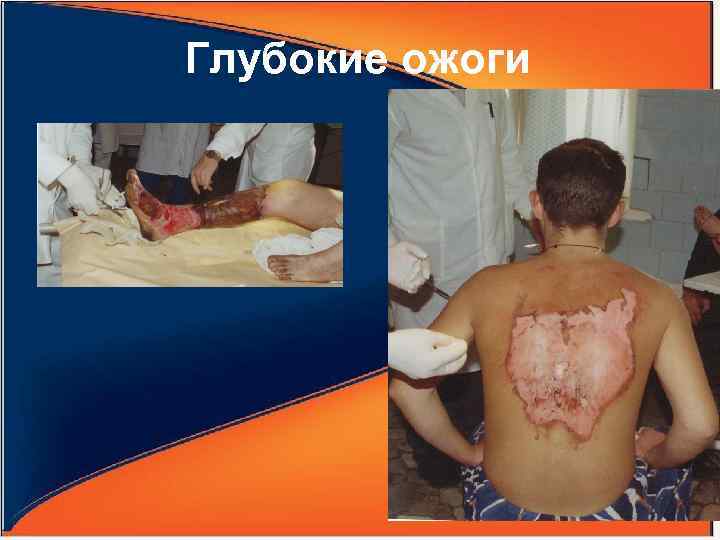 Глубокие ожоги 