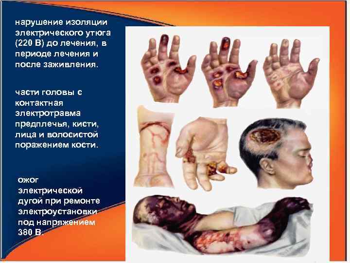 нарушение изоляции электрического утюга (220 В) до лечения, в периоде лечения и после заживления.