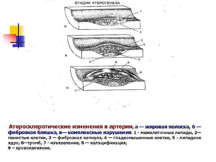 Атеросклеротические изменения в артерии, а — жировая полоска, б — фиброзная бляшка, в— комплексные