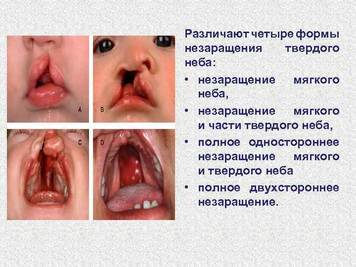 Различают четыре формы незаращения твердого неба: • незаращение мягкого неба, • незаращение мягкого и