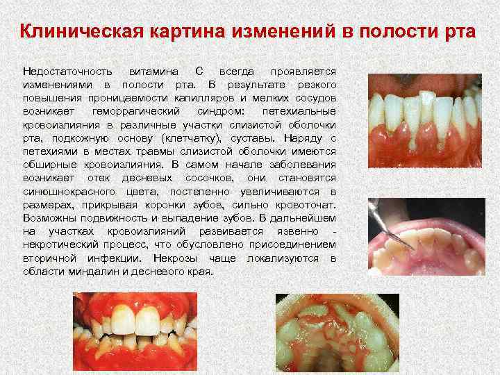Клиническая картина изменений в полости рта Недостаточность витамина С всегда проявляется изменениями в полости
