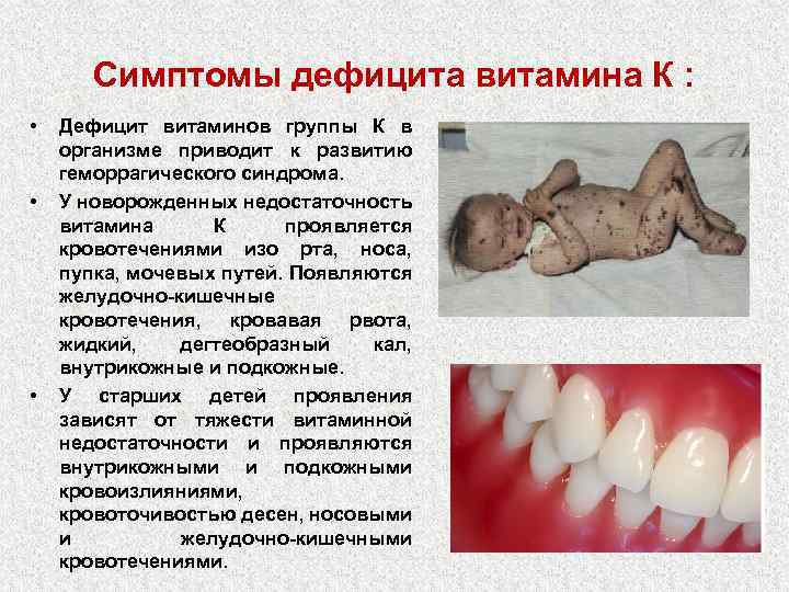 Симптомы дефицита витамина К : • • • Дефицит витаминов группы К в организме