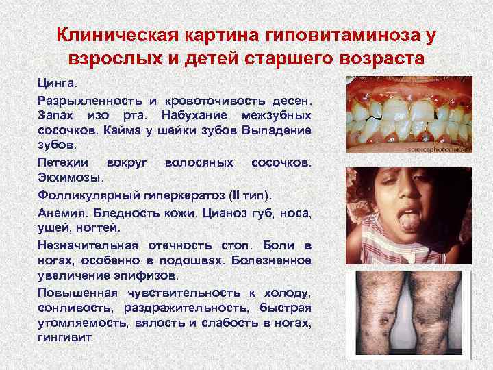 Клиническая картина гиповитаминоза у взрослых и детей старшего возраста Цинга. Разрыхленность и кровоточивость десен.