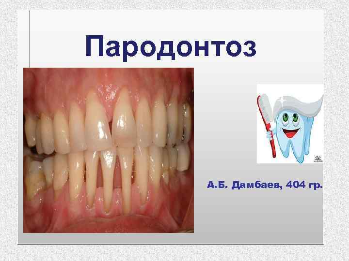 Пародонтоз А. Б. Дамбаев, 404 гр. 