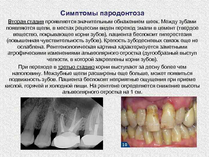 Симптомы пародонтоза Вторая стадия проявляется значительным обнажением шеек. Между зубами появляются щели, в местах