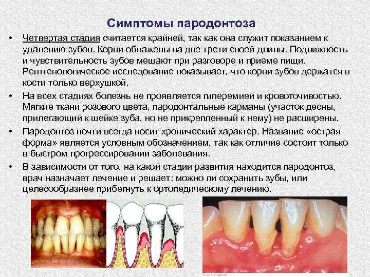 Симптомы пародонтоза • • Четвертая стадия считается крайней, так как она служит показанием к