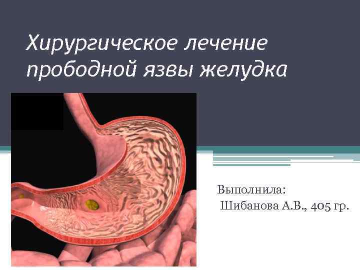 Хирургическое лечение прободной язвы желудка Выполнила: Шибанова А. В. , 405 гр. 