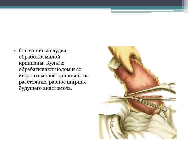  • Отсечение желудка, обработка малой кривизны. Культю обрабатывают йодом и со стороны малой