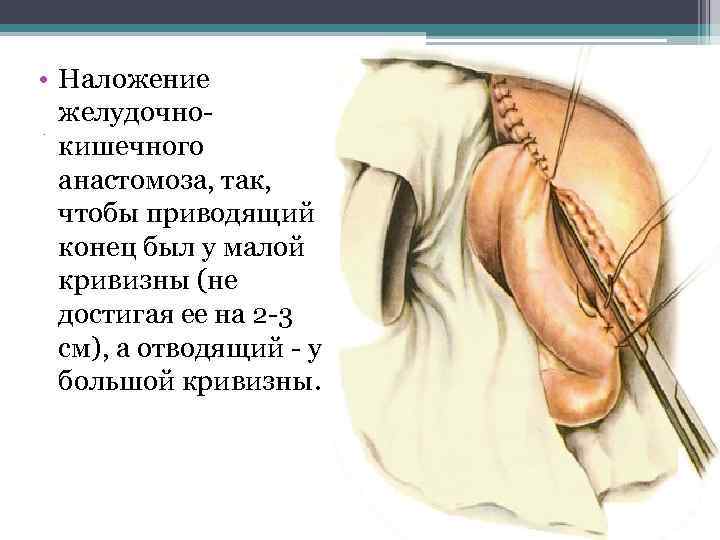  • Наложение желудочнокишечного анастомоза, так, чтобы приводящий конец был у малой кривизны (не