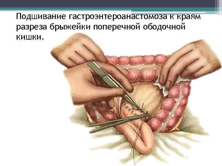 Подшивание гастроэнтероaнастомоза к краям разреза брыжейки поперечной ободочной кишки. 