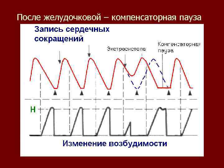 После желудочковой – компенсаторная пауза 