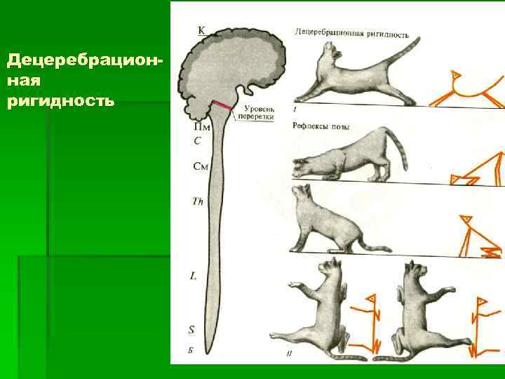 Децеребрационная ригидность 