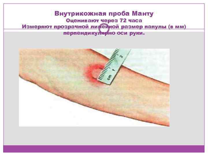 Внутрикожная проба Манту Оценивают через 72 часа Измеряют прозрачной линейкой размер папулы (в мм)