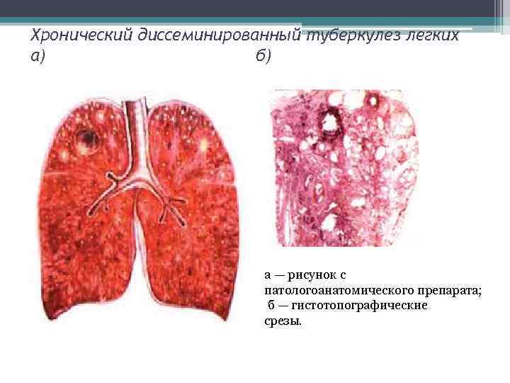 Диссеминированный туберкулез легких картинки